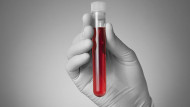 علاج فقر الدم المنجلي بالخلايا الجذعية والعلاج الوراثي